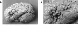 Il cervello di Leborgne: si nota l'area cerebrale lesionata (foto B) nell'emisfero sinistro.